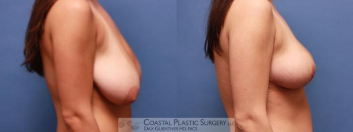 Before & After Breast Reduction Case 20 View #3 View in Boston, MA