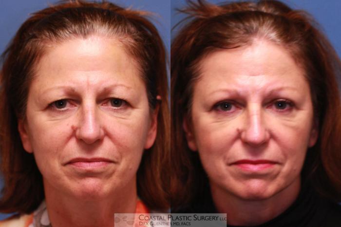 Before & After Brow Lift Case 32 View #1 View in Hingham, MA