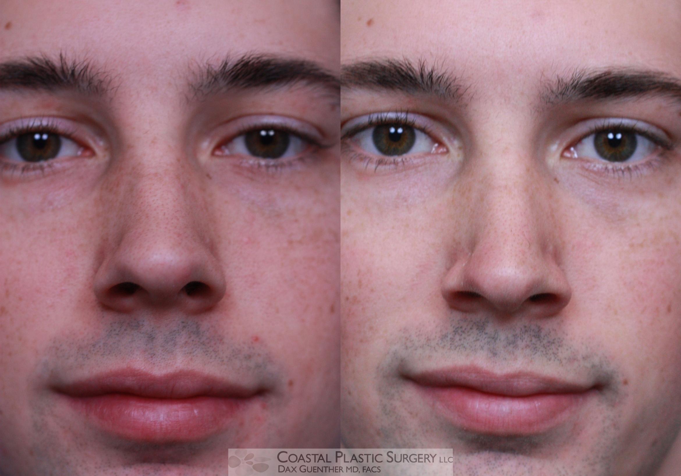 Before & After Chemical Peels & Lasers/Lights Case 79 View #1 View in Hingham, Boston & Nantucket, MA