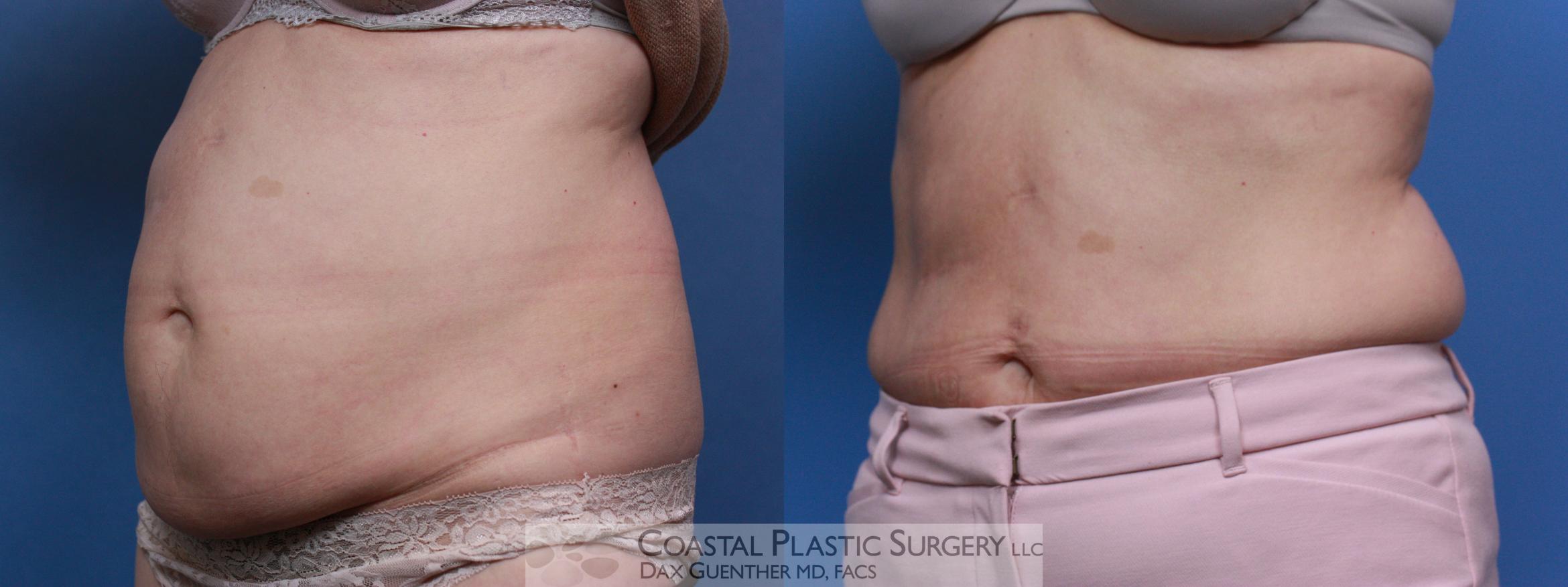 Before & After CoolSculpting Case 109 Left Oblique View in Hingham, Boston & Nantucket, MA