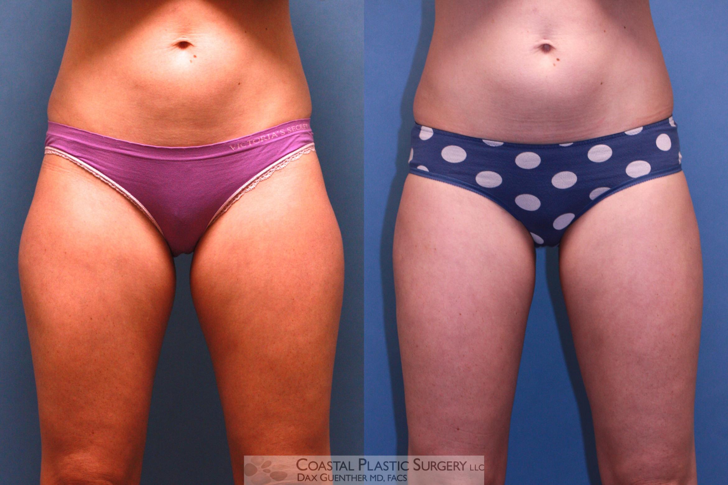 Before & After CoolSculpting Case 36 View #1 View in Hingham, Boston & Nantucket, MA