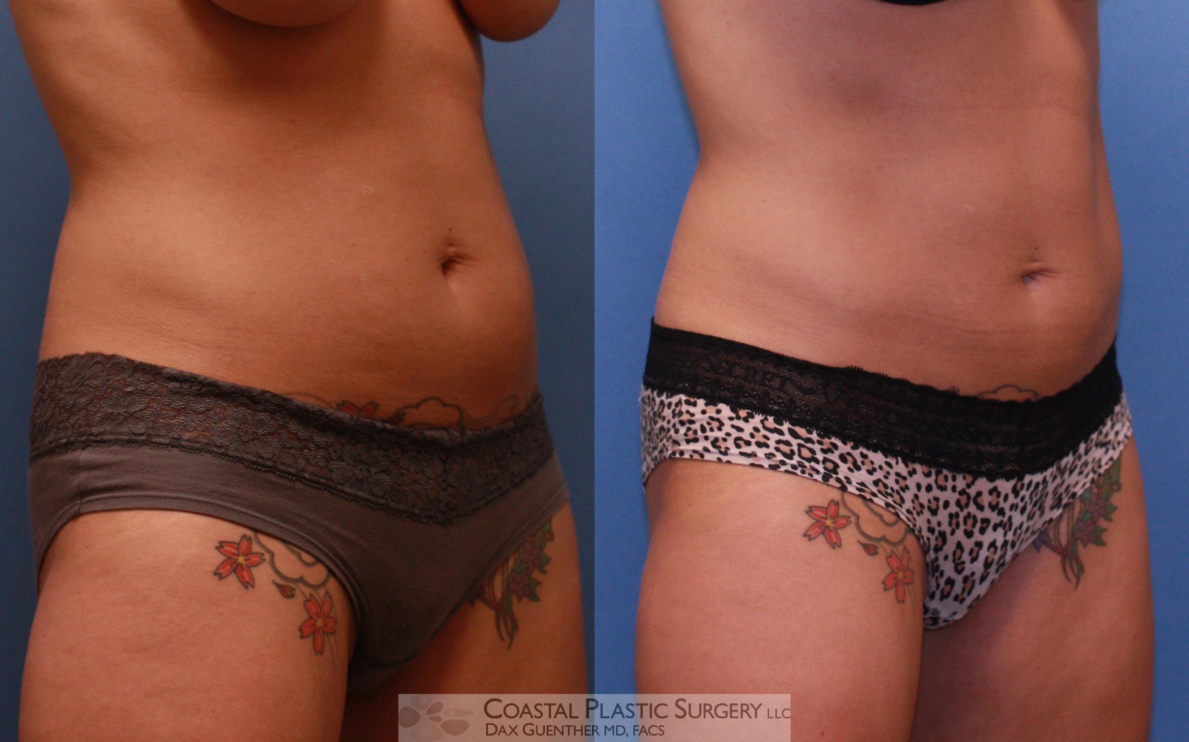 Before & After CoolSculpting Case 62 View #3 View in Hingham, Boston & Nantucket, MA