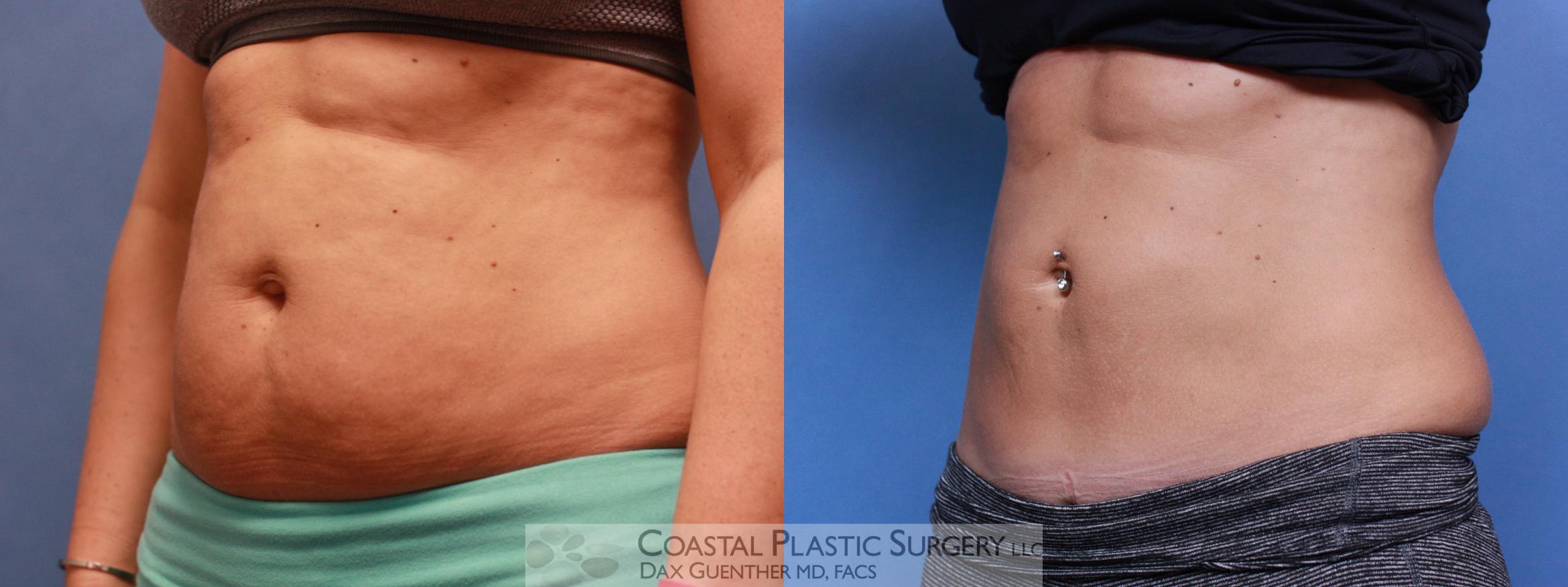 Before & After CoolSculpting Case 78 View #2 View in Hingham, Boston & Nantucket, MA
