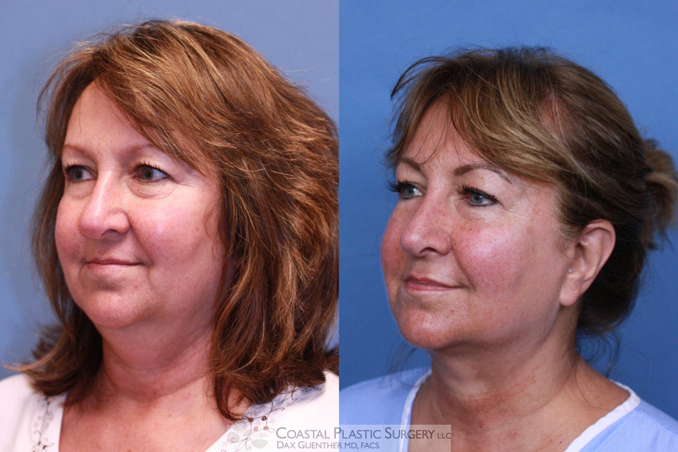 Before & After CoolSculpting® Elite Case 81 View #2 View in Hingham, Boston & Nantucket, MA
