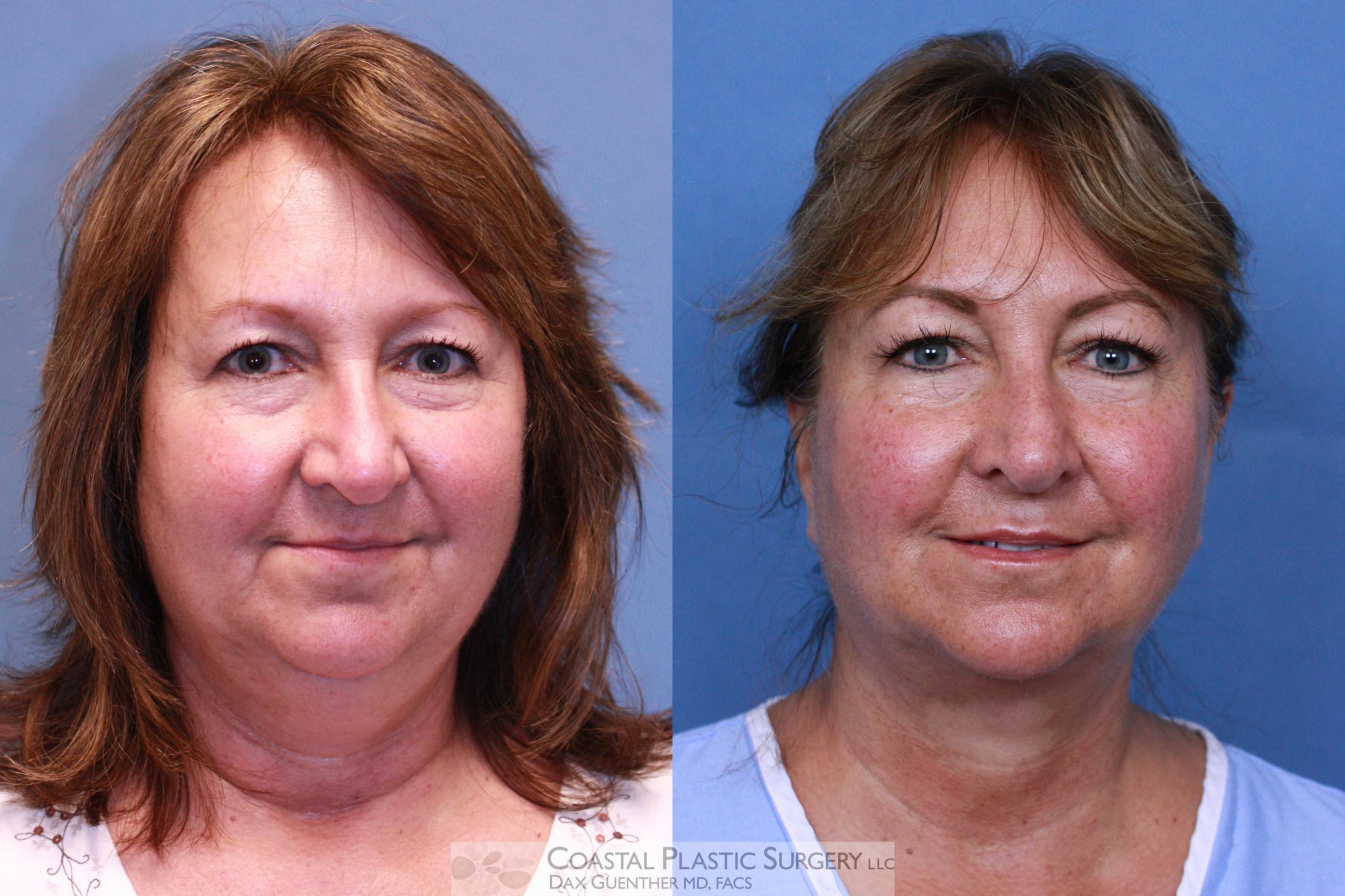 Before & After CoolSculpting® Elite Case 81 View #3 View in Hingham, Boston & Nantucket, MA