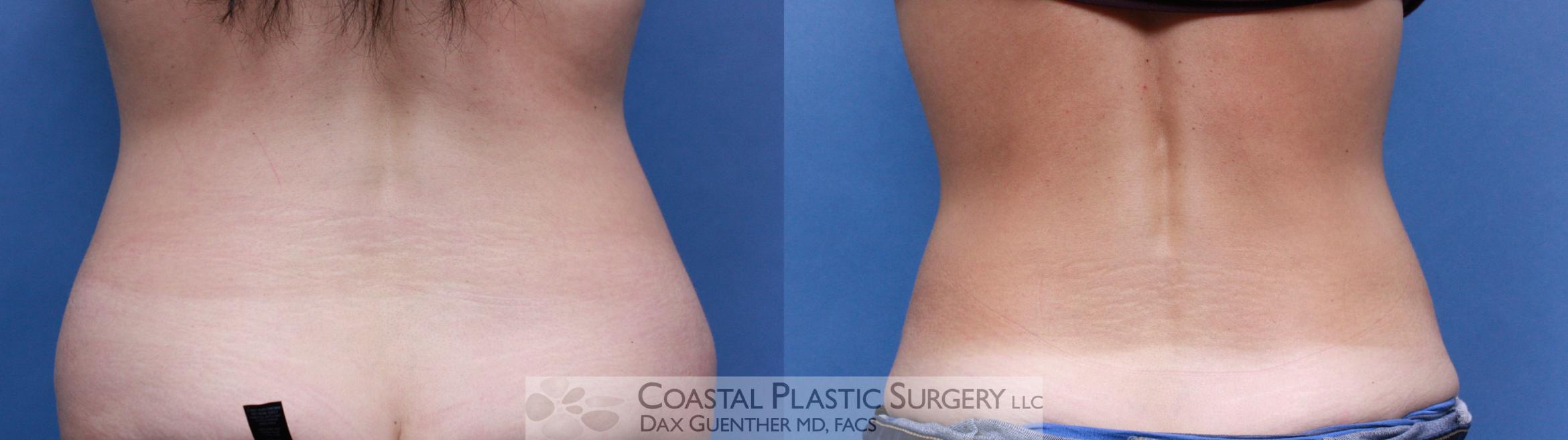 Before & After CoolSculpting Case 90 View #1 View in Hingham, Boston & Nantucket, MA