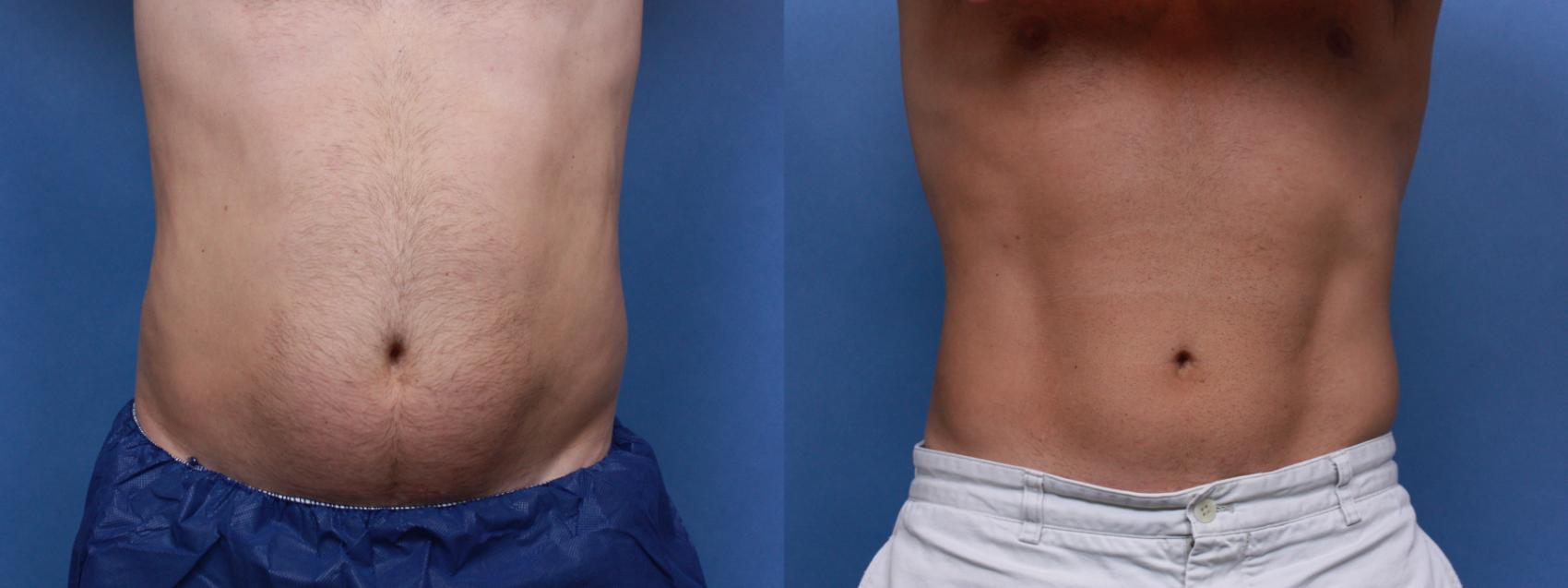 Before & After CoolSculpting® Elite Case 104 Front View in Boston, MA