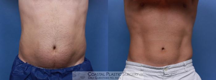 Before & After CoolSculpting® Elite Case 104 Front View in Boston, MA