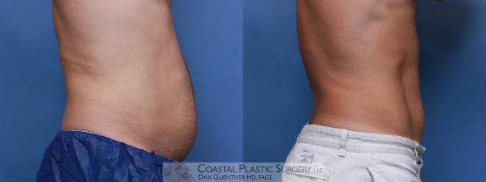 Before & After CoolSculpting® Elite Case 104 Right Side View in Boston, MA