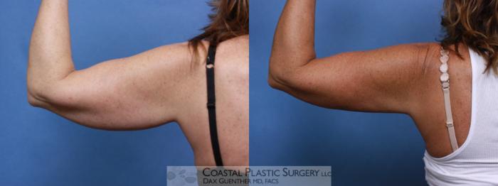 Before & After CoolSculpting® Elite Case 108 Back View in Boston, MA