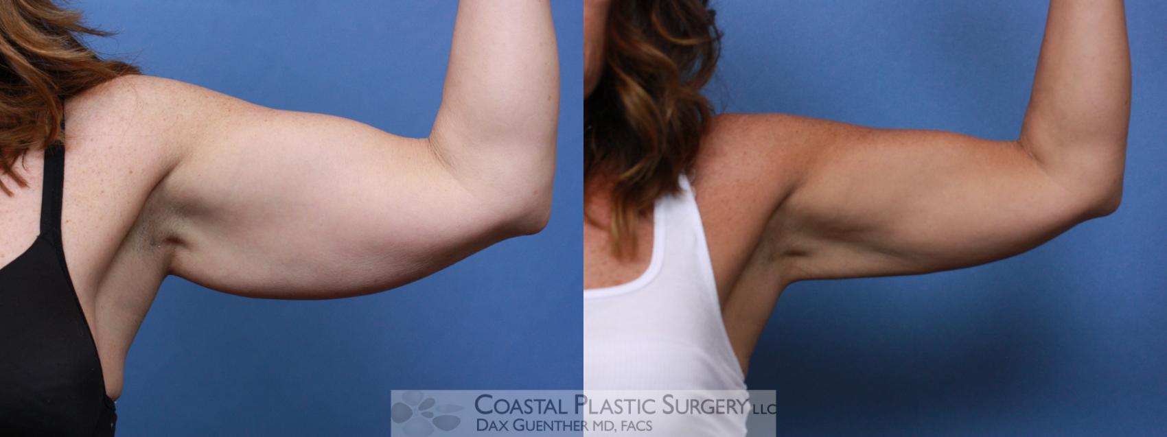 Before & After CoolSculpting® Elite Case 108 Front View in Hingham, MA