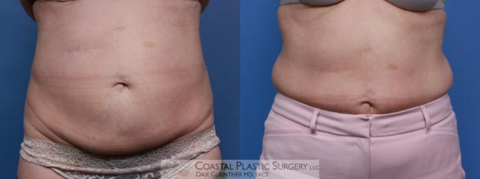 Before & After CoolSculpting® Elite Case 109 Front View in Boston, MA