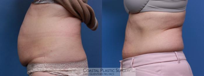 Before & After CoolSculpting® Elite Case 109 Left Side View in Boston, MA