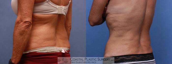 Before & After CoolSculpting® Elite Case 110 Left Oblique View in Boston, MA