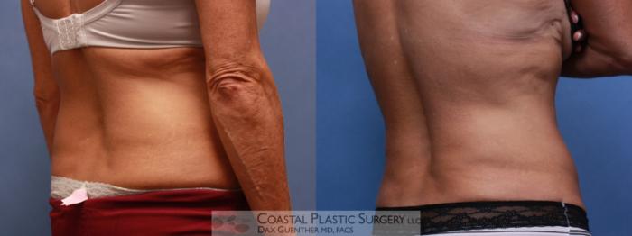 Before & After CoolSculpting® Elite Case 110 Right Oblique View in Boston, MA