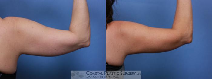 Before & After CoolSculpting® Elite Case 111 Back View in Boston, MA