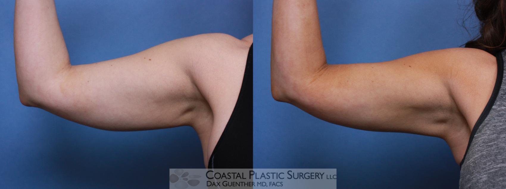 Before & After CoolSculpting® Elite Case 111 Front View in Boston, MA