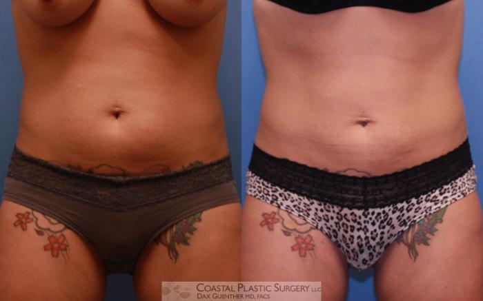 Before & After CoolSculpting® Elite Case 62 View #1 View in Boston, MA