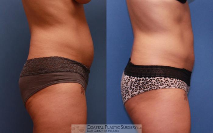 Before & After CoolSculpting® Elite Case 62 View #2 View in Boston, MA