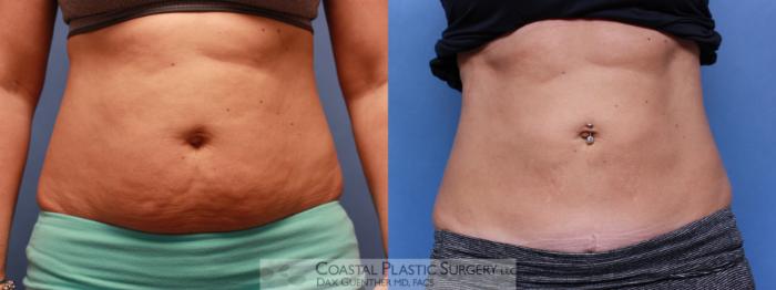 Before & After CoolSculpting® Elite Case 78 View #1 View in Boston, MA
