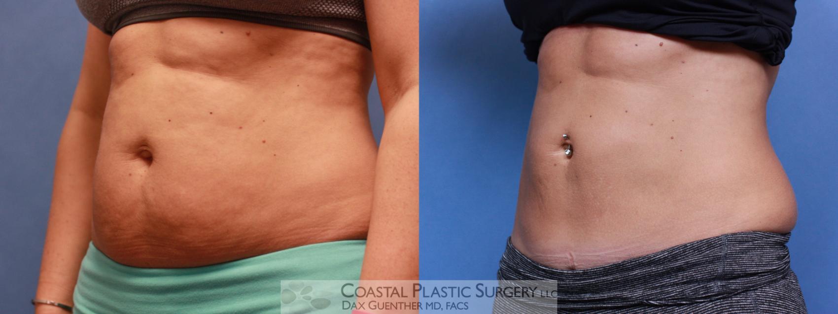 Before & After CoolSculpting® Elite Case 78 View #2 View in Hingham, MA