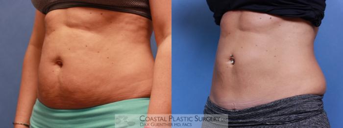 Before & After CoolSculpting® Elite Case 78 View #2 View in Boston, MA