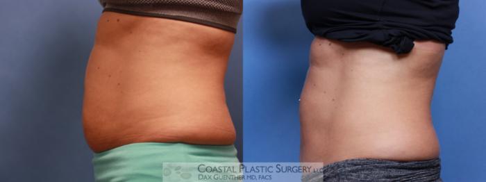 Before & After CoolSculpting® Elite Case 78 View #3 View in Boston, MA