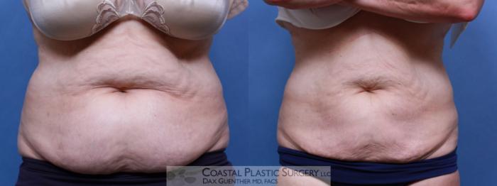 Before & After CoolSculpting® Elite Case 80 View #1 View in Boston, MA