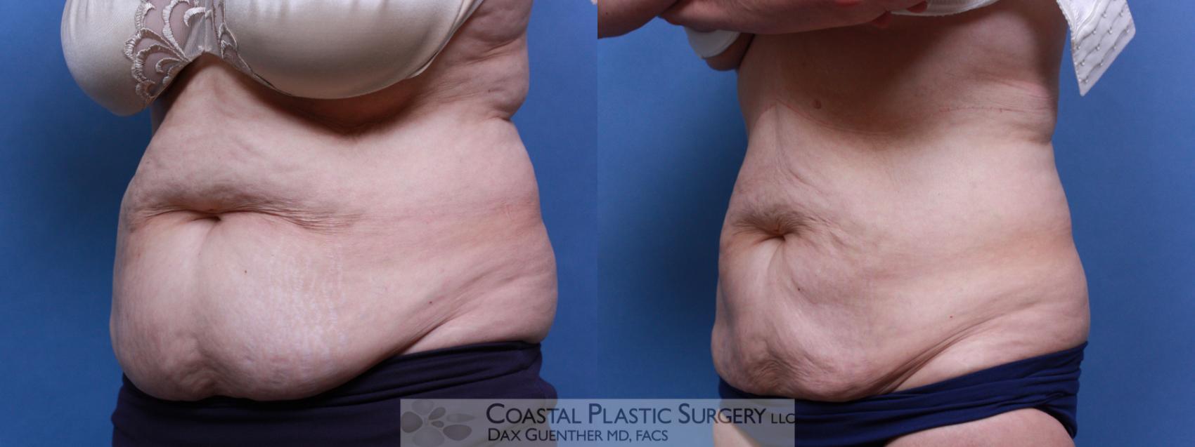 Before & After CoolSculpting® Elite Case 80 View #3 View in Hingham, MA