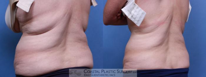 Before & After CoolSculpting® Elite Case 80 View #4 View in Boston, MA