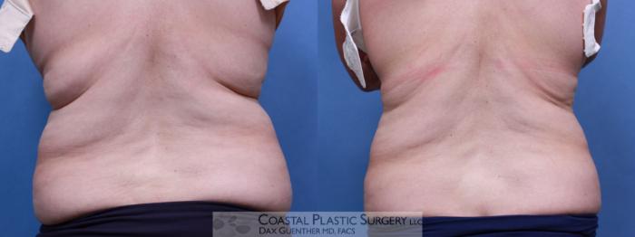 Before & After CoolSculpting® Elite Case 80 View #5 View in Boston, MA