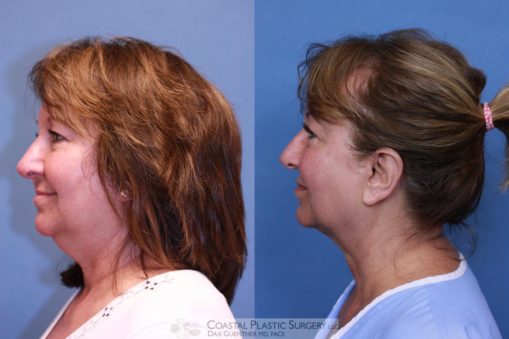 Before & After CoolSculpting® Elite Case 81 View #1 View in Hingham, MA