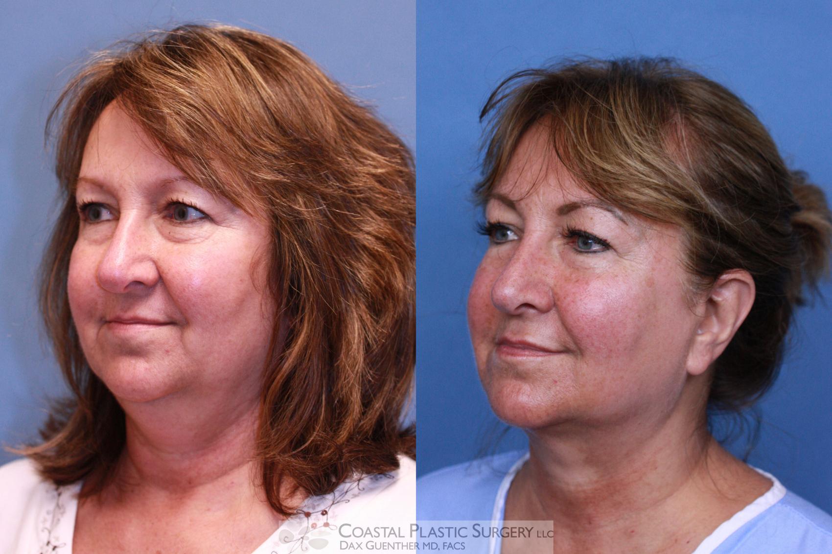 Before & After CoolSculpting® Elite Case 81 View #2 View in Boston, MA
