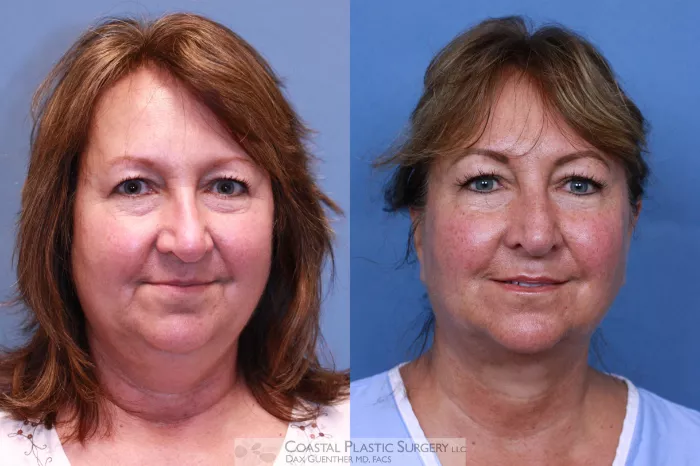 CoolSculpting® Elite Before & After Photos Patient 105, Boston, MA