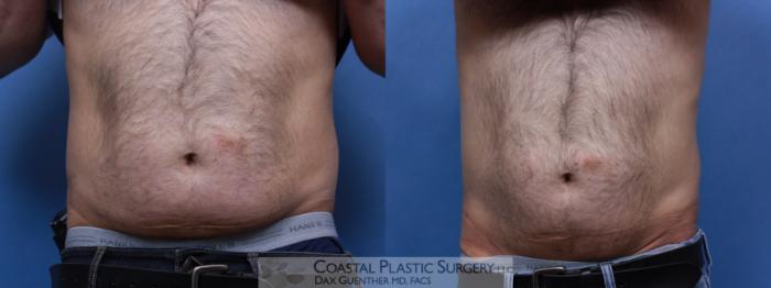 Before & After CoolSculpting® Elite Case 85 View #1 View in Boston, MA