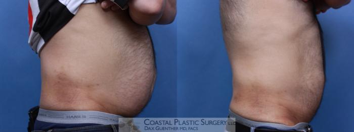 Before & After CoolSculpting® Elite Case 85 View #2 View in Boston, MA