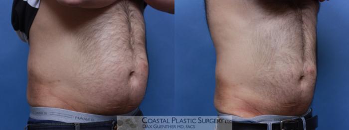 Before & After CoolSculpting® Elite Case 85 View #3 View in Hingham, MA