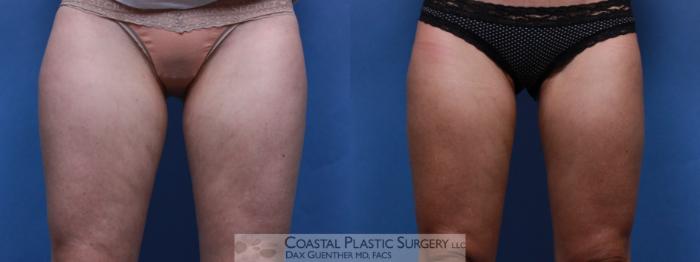 Before & After CoolSculpting® Elite Case 86 View #1 View in Hingham, MA