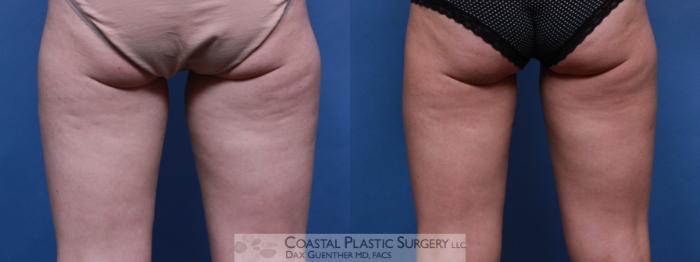 Before & After CoolSculpting® Elite Case 86 View #2 View in Boston, MA