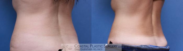 Before & After CoolSculpting® Elite Case 90 View #2 View in Boston, MA