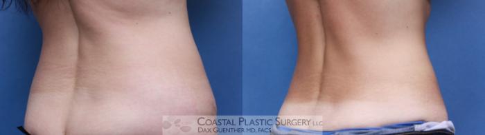 Before & After CoolSculpting® Elite Case 90 View #3 View in Boston, MA