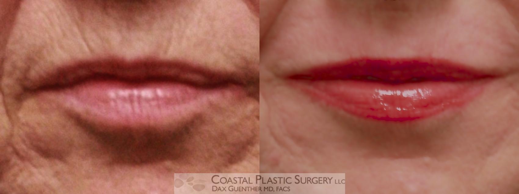 Before & After Dermabrasion Case 30 View #1 View in Hingham, Boston & Nantucket, MA