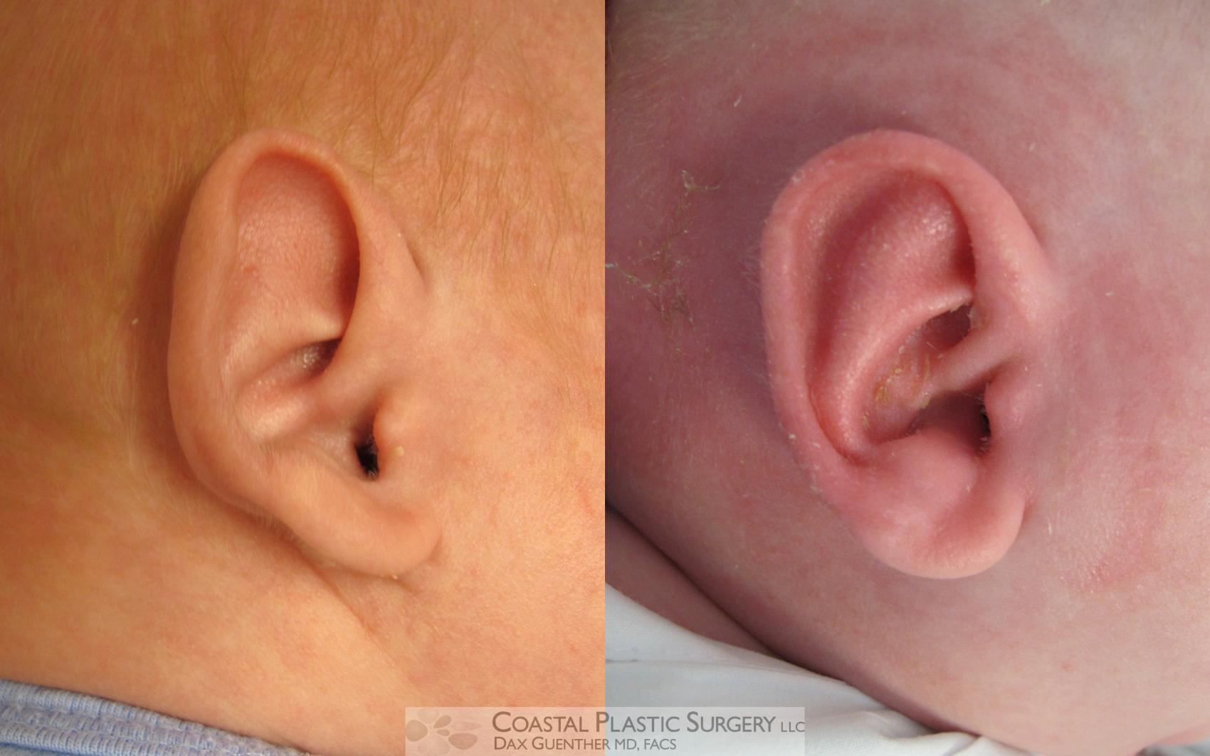 Before & After Ear Pinning (Otoplasty) Case 9 View #1 View in Hingham, Boston & Nantucket, MA