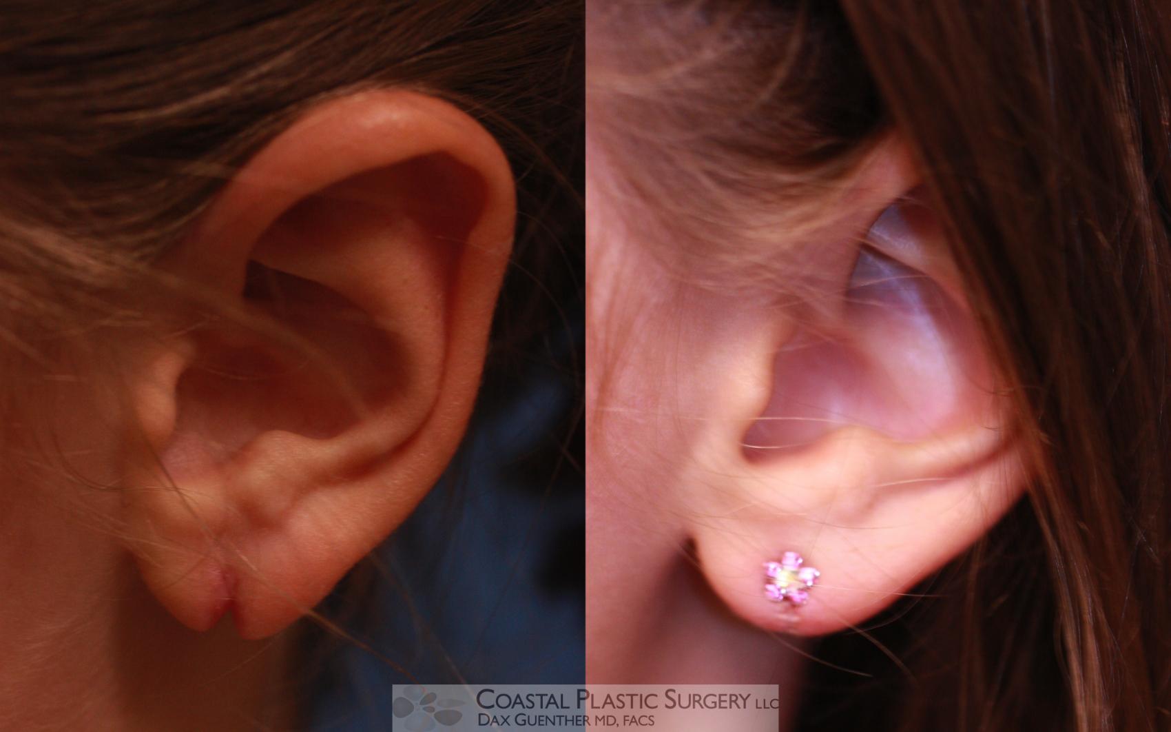 Before & After Earlobe Repair Case 11 View #1 View in Boston, MA
