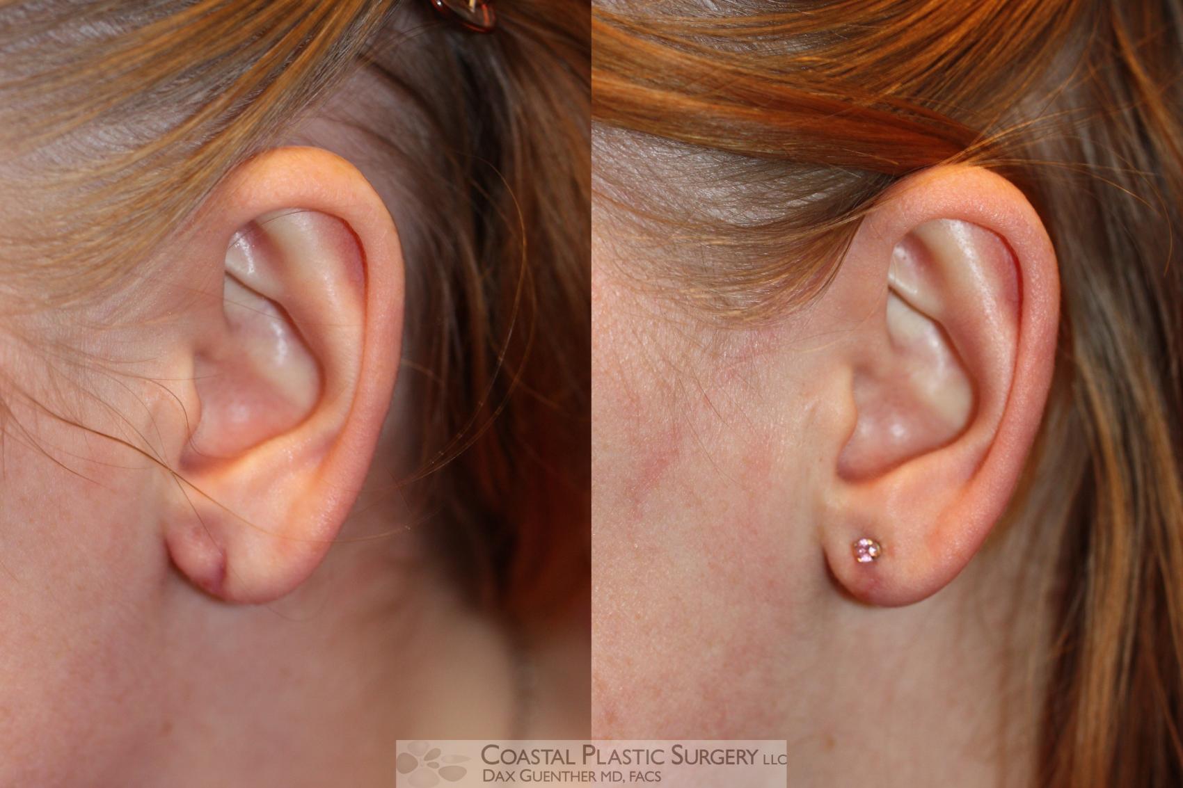Before & After Earlobe Repair Case 55 View #1 View in Boston, MA