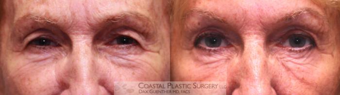Before & After Eyelid Surgery (Blepharoplasty) Case 26 View #1 View in Hingham, MA