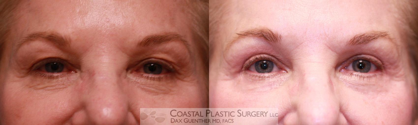 Before & After Eyelid Surgery (Blepharoplasty) Case 52 View #1 View in Hingham, Boston & Nantucket, MA