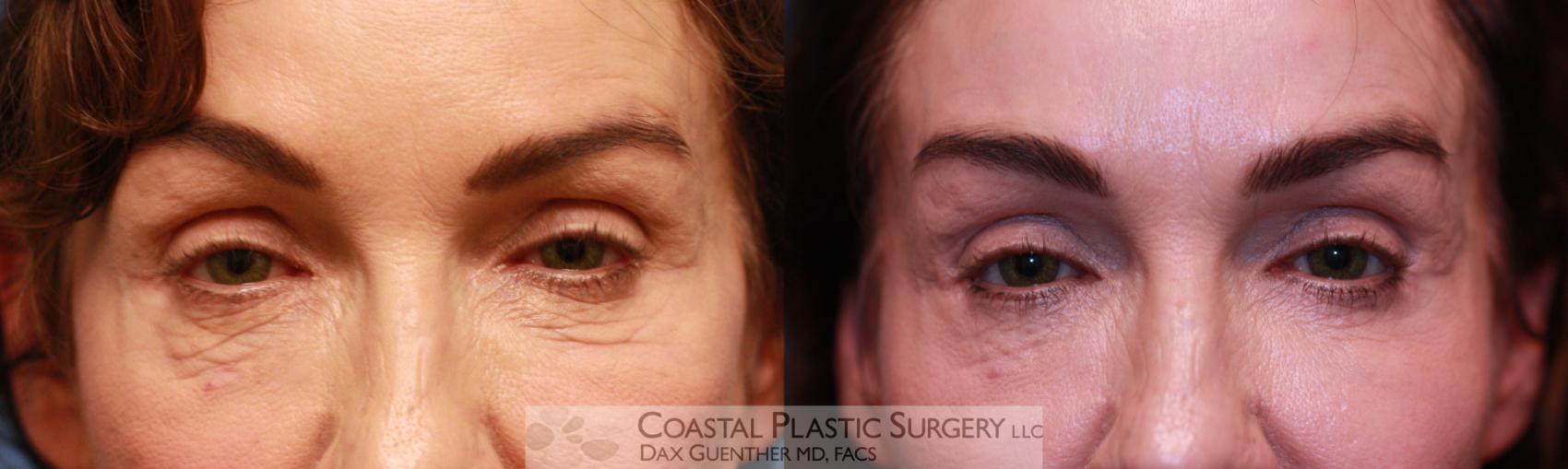 Before & After Eyelid Surgery (Blepharoplasty) Case 53 View #1 View in Hingham, MA
