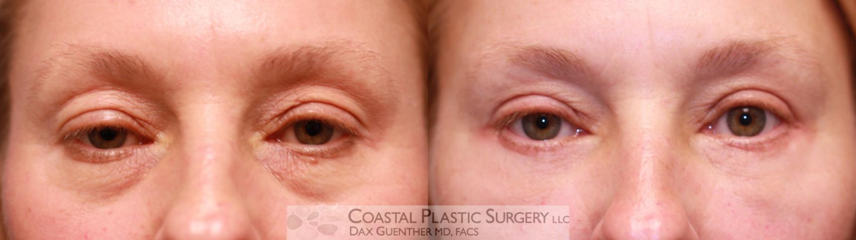 Before & After Eyelid Surgery (Blepharoplasty) Case 60 View #1 View in Hingham, Boston & Nantucket, MA