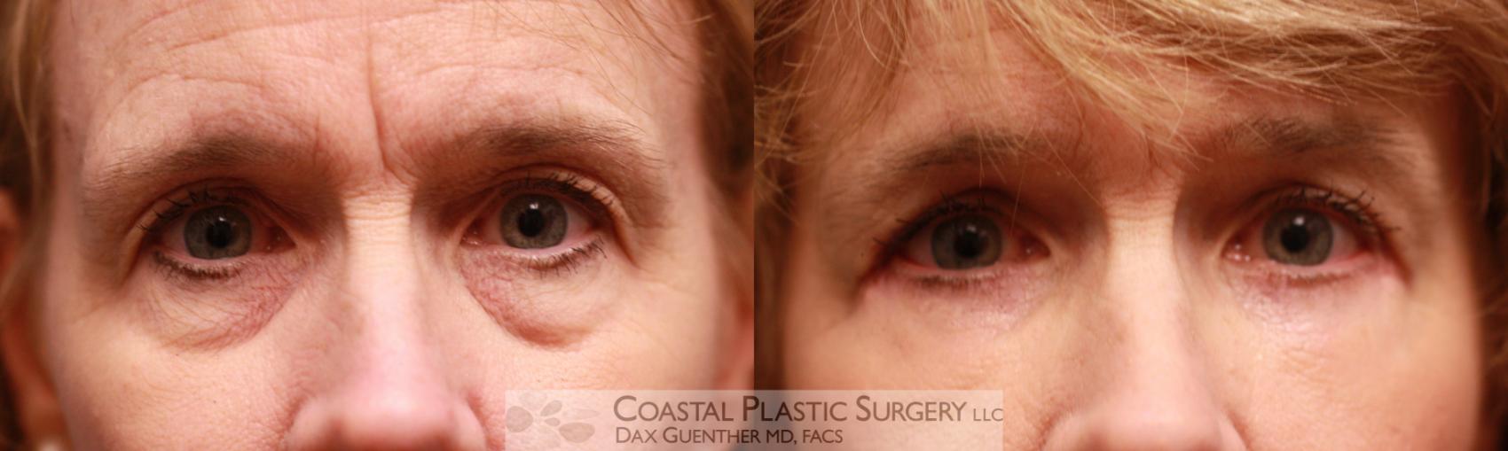 Before & After Eyelid Surgery (Blepharoplasty) Case 77 View #1 View in Hingham, MA